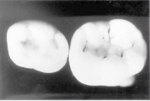 molars-pitsandfissures-glennphoto.jpg